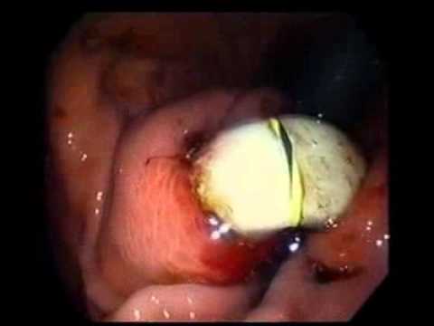 Endoskopowe usunięcie regulowanej opaski żołądkowej z powodu perforacji ściany żołądka