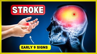 Watch Out! These 9 Stroke Symptoms Could Save Your Life!