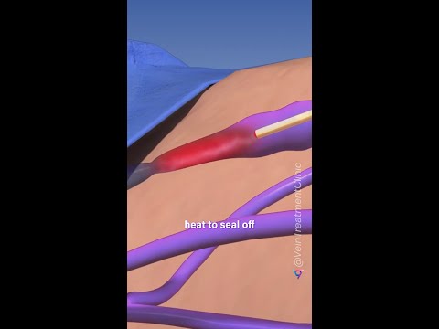 Radiofrequency ablation for vein treatments