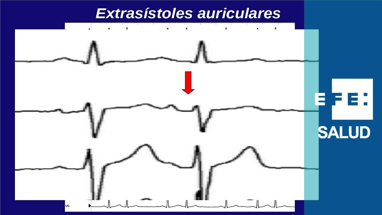 Taquicardia: La extrasístole, casi una arritmia benigna