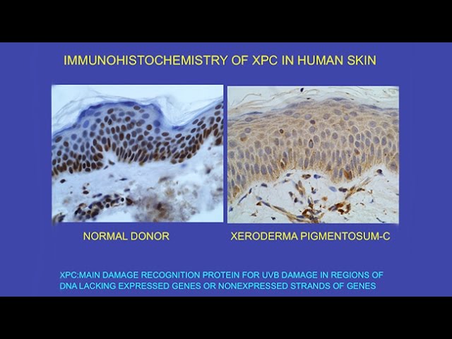 Video Pronunciation of xeroderma pigmentosum in English Video Pronunciation of xeroderma pigmentosum in English
