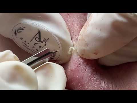 ACNE UNDER THE SKIN – Acne Treatment Mai Ngoc