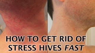 Stress Hives Treatment - How To Get Rid Of A Stress Rash FAST!