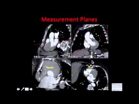 Pre-Operative CT Evaluation of TAVR