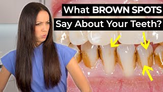 What Do BROWN SPOTS on Your Teeth Mean?