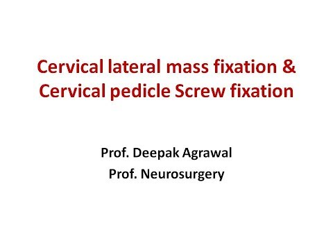 Cervical lateral mass & Cervical pedicle Screw fixation