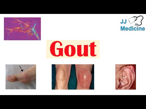 Gout | Causes, Pathophysiology, Risk Factors (ex. Diet), Symptoms, Diagnosis, Treatment