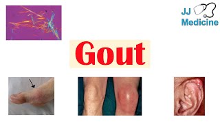 Download Lagu Gout | Causes, Pathophysiology, Risk Factors (ex. Diet), Symptoms, Diagnosis, Treatment Thumbnail