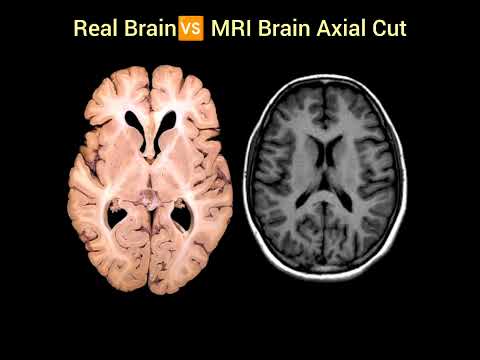 Real Brain 🆚 MRI Brain Image #aiims #shortsvideo #biology #doctor #mbbs