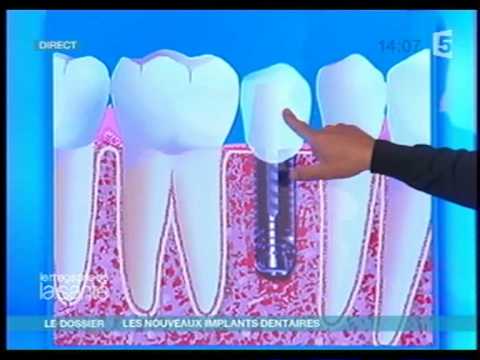comment se faire rembourser implant dentaire