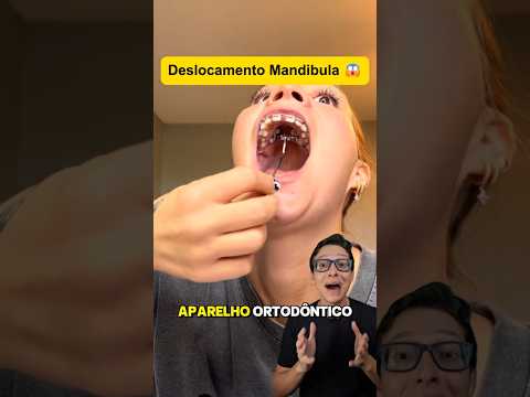 Deslocamento de Mandíbula #medicina #medico #enfermagem #enfermeiro #enfermeira #curiosidade Travada