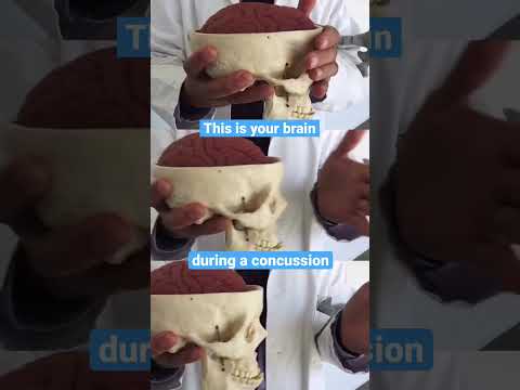 This is your brain during a concussion 😬 🧠 😱