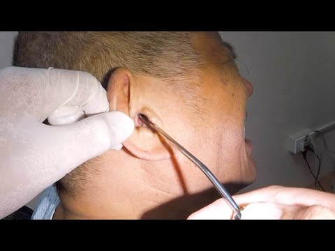 This is How to Remove Man's Rock Hard Earwax