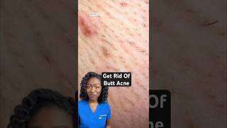 Butt Acne 🍑 Why You Get It & How to Get Rid of It!