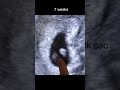 7 Weeks Pregnancy Ultrasound Scan | Wow moment #shorts #drsita #mindbodycare