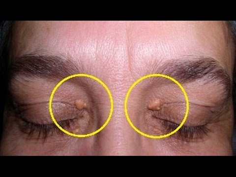 Lemak visceral mendapatkan Produk menyingkirkan Apakah membungkus dapat menghapus lemak perut