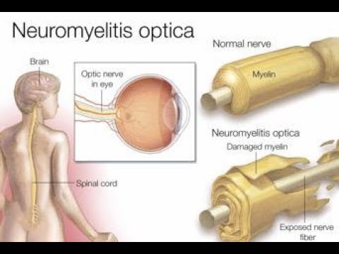 Neuromyelitis Optica (Devic's Disease) ; Definition, Causes, Symptoms, Diagnosis, Treatment