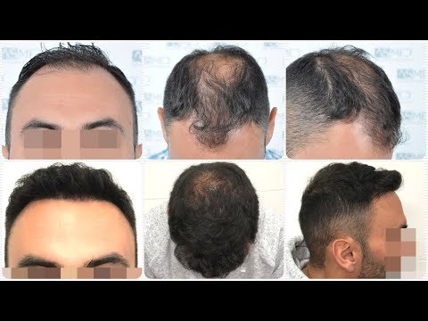 Manual FUE Hair Transplant Before & After, 5006 Grafts Result - ASMED - Dr. Koray Erdogan