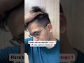 Watch To Identify Male Pattern Baldness Manmatters Malepatternbaldness Hairfallsolution Hairfall