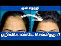 How To Treat Forehead Hair Loss Treatment For FAST REGROW