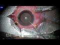 Silicone OIl Removal With ILM Peeling