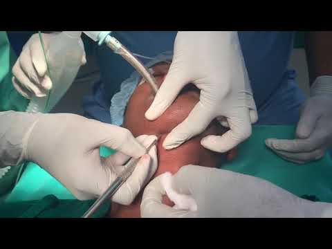 Submental Intubation For Maxillofacial Procedures