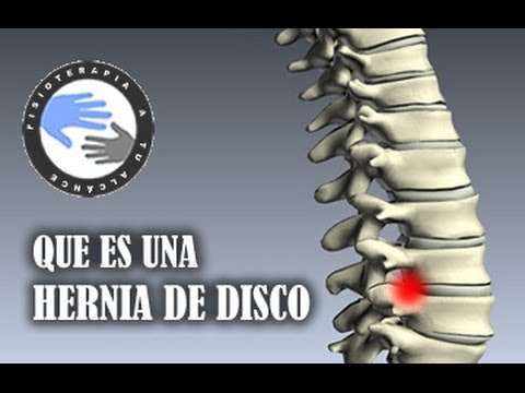 Hernia discal, que es y como se produce