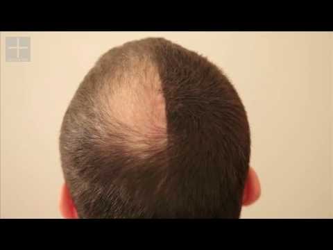 Professional Hair - Hair Fiber - Schütthaar - Vergleichstest