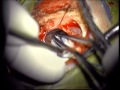 Microvascular Decompression for Treatment of Trigeminal Neuralgia 2