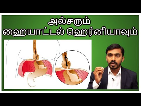 அல்சரும் ஹையாட்டல் ஹெர்னியாவும் என்ன சம்மந்தம்  l Hiatus hernia in Tamil dr Sj hot tv