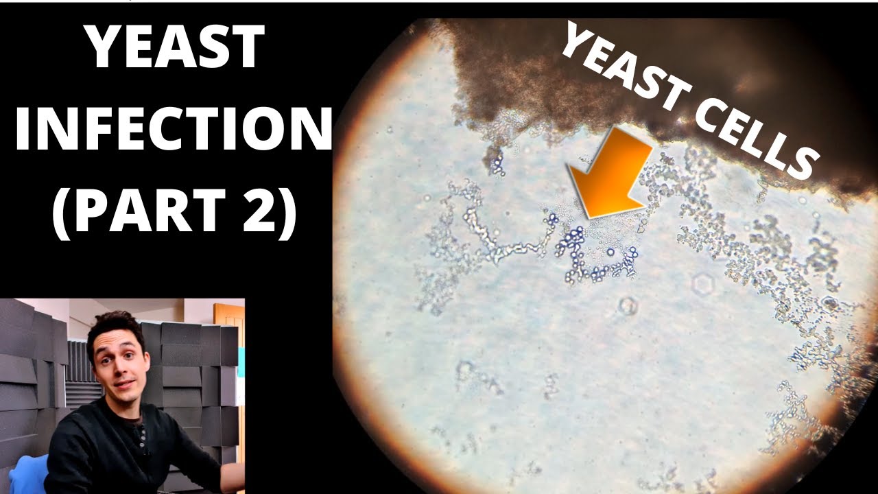What does yeast infection look like under a microscope? More REF