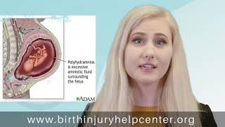Polyhydramnios (Too Much Amniotic Fluid)