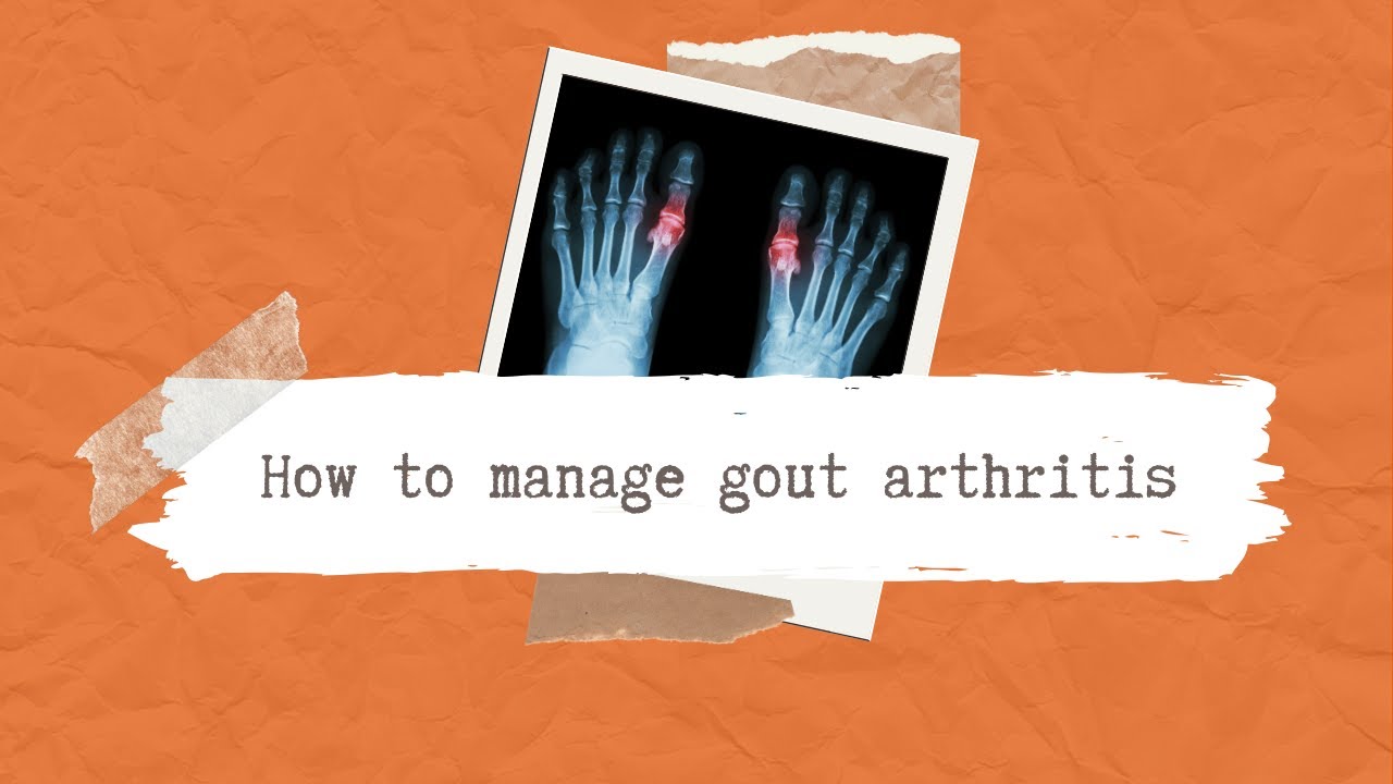 How to manage gout arthritis for health professionals