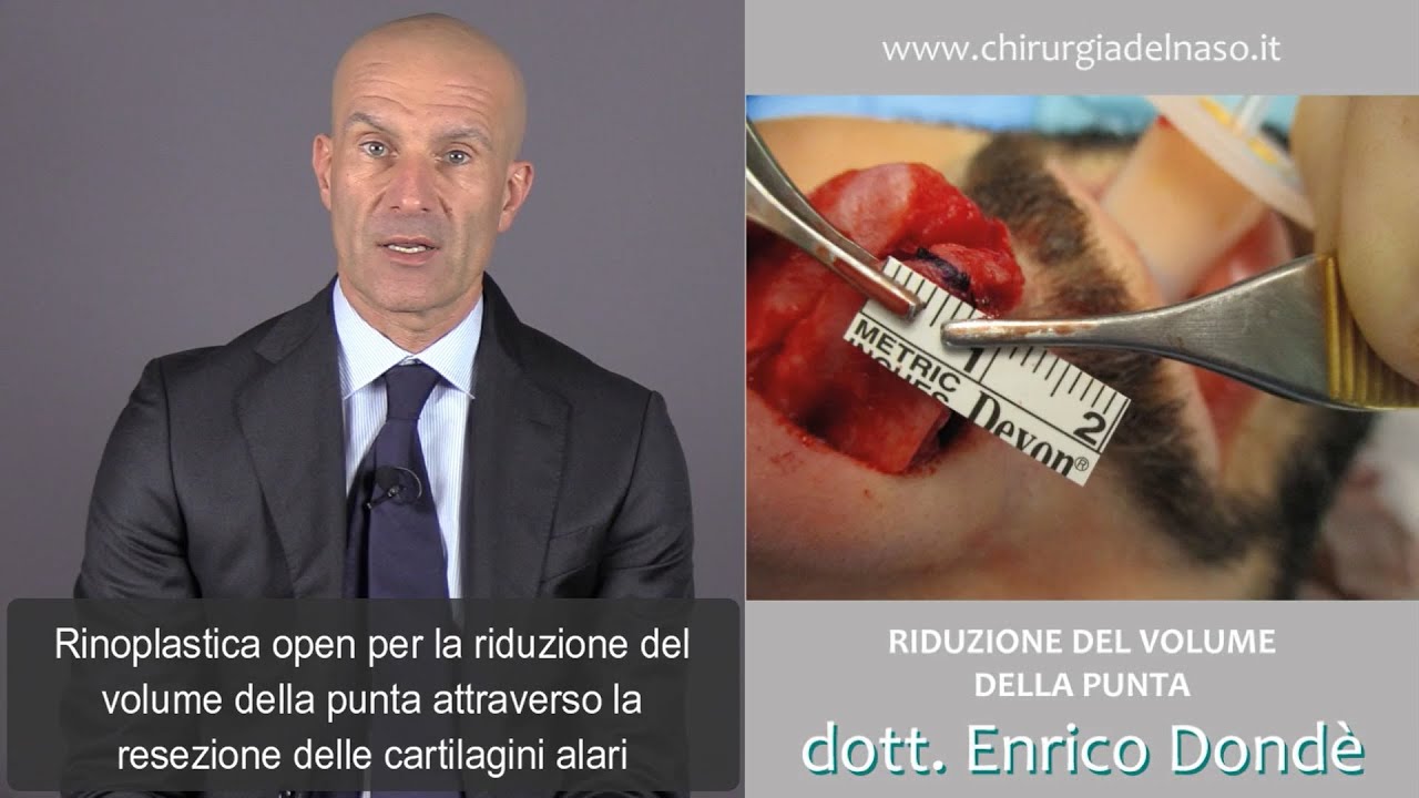 Rinoplastica di riduzione del volume della punta | Dr. Enrico Dondè