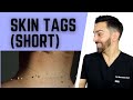 Skin Tags aka Acrochordons #shorts