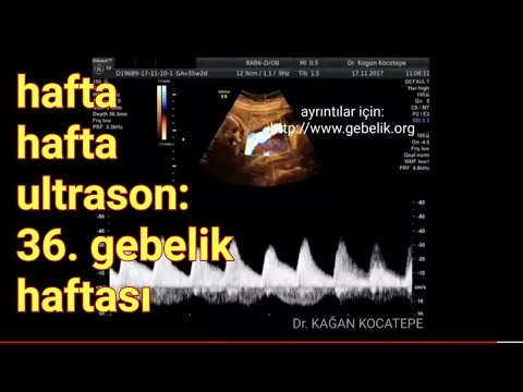36. gebelik haftasında anne karnındaki bebek - az kilo alımı, solunum hareketleri ve renkli Doppler