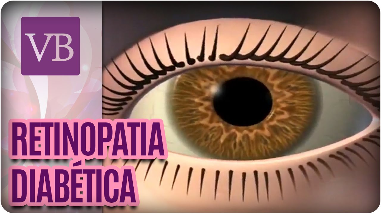 Retinopatia Diabética - Você Bonita (13/09/16)