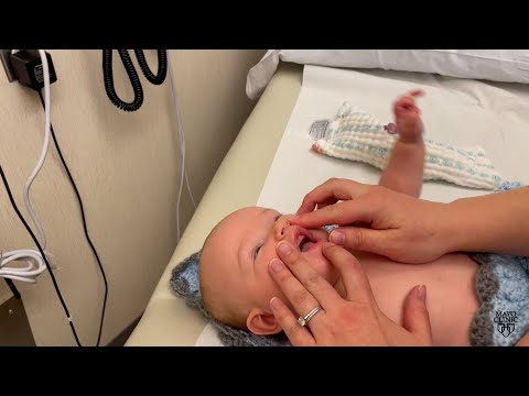 Mayo Clinic Minute: Tongue-tie in babies