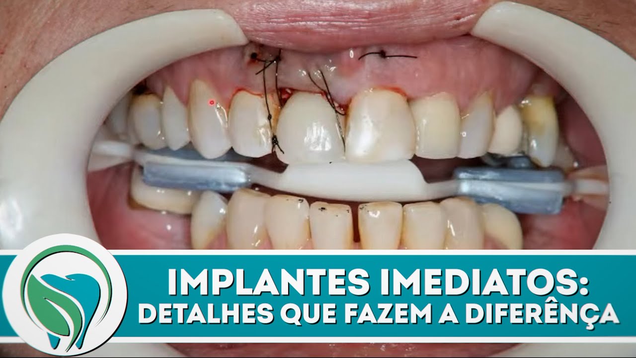 Implantes em imediatos | Detalhes que fazem a diferença!