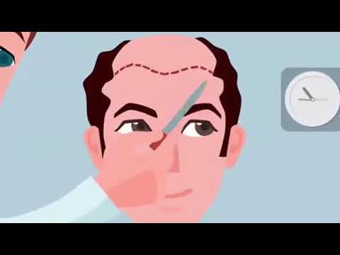 Hair Transplant Turkey