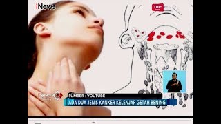 Benjolan di Leher, Kenali Ciri Kanker Kelenjar Getah Bening - iNews Siang 03/08