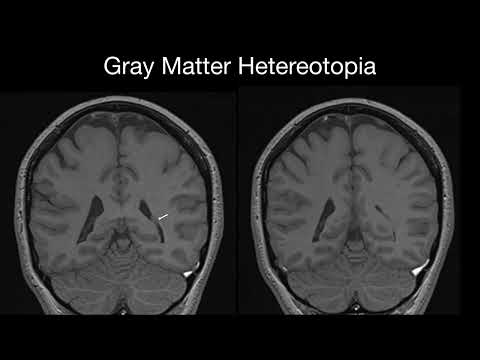 Gray matter Heterotopia