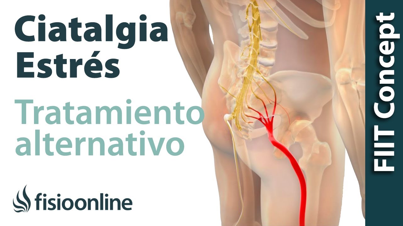 Ciática o ciatalgia y el estrés - Visión desde la medicina natural