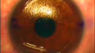 Lasik eye surgery: Full length