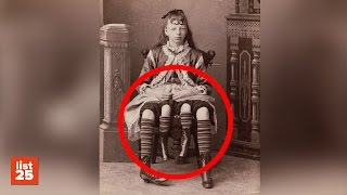 25 STRANGE Birth Defects Few Kids Are Born With