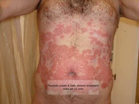 Rimedio di gente da eczema secco su mani Come guarire il bambino con neurodermatitis