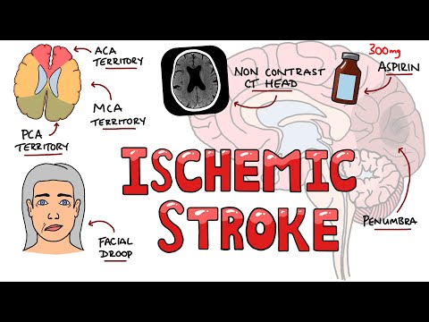 Acute Ischemic Stroke - Signs and Symptoms (Stroke Syndromes) | Causes & Mechanisms | Treatment