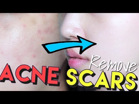 La decolorazione di crema con iodio Se tolto chi lentiggini un peeling
