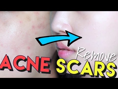 How To Get Rid of Acne Scars & Hyperpigmentation • Get Brighter Skin! Video