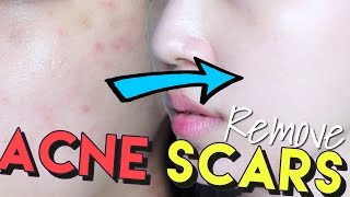How To Get Rid of Acne Scars & Hyperpigmentation • Get Brighter Skin!